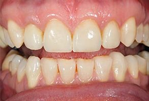 The Villages Before and After Teeth Whitening