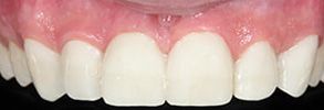 32162 Before and After Teeth Whitening