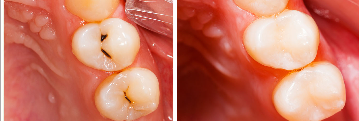 Dentistry on the Square | Digital Radiography, Oral Exams and Crowns